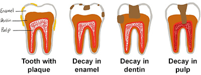Cavities: What are They and How Do We Prevent Them?