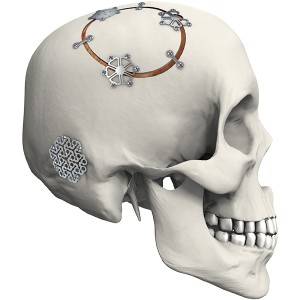 skull interlink plate – 2 holes