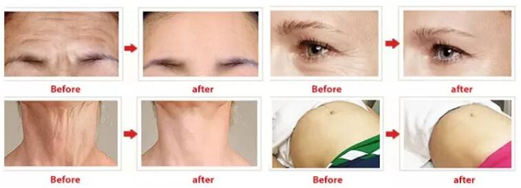 Popular beauty machine skin rejuvenation rinkle removal ultrasonic 4D Vmax H