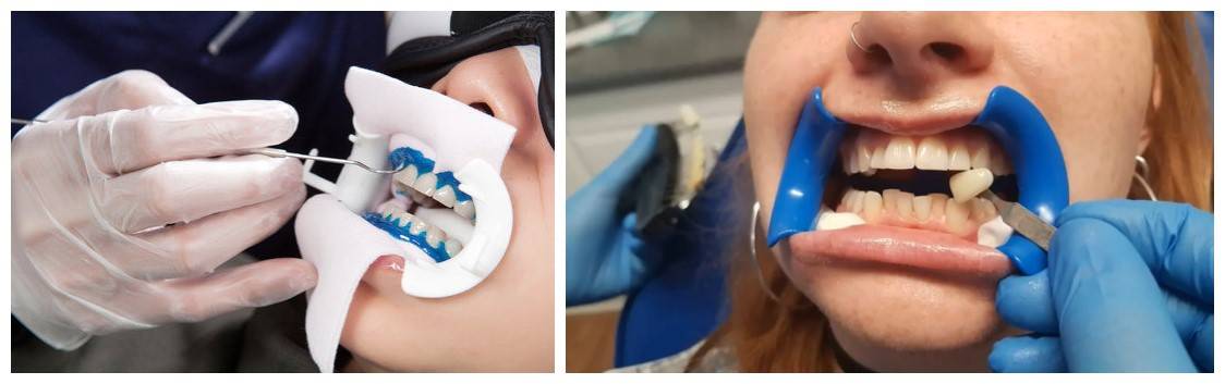 teeth-whitening-service